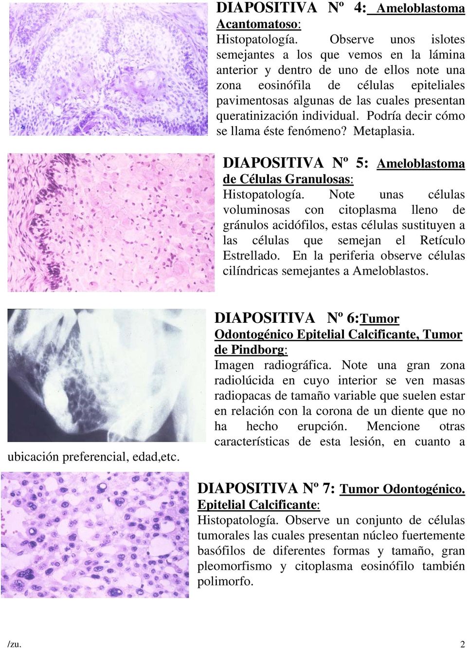 queratinización individual. Podría decir cómo se llama éste fenómeno? Metaplasia. DIAPOSITIVA Nº 5: Ameloblastoma de Células Granulosas: Histopatología.