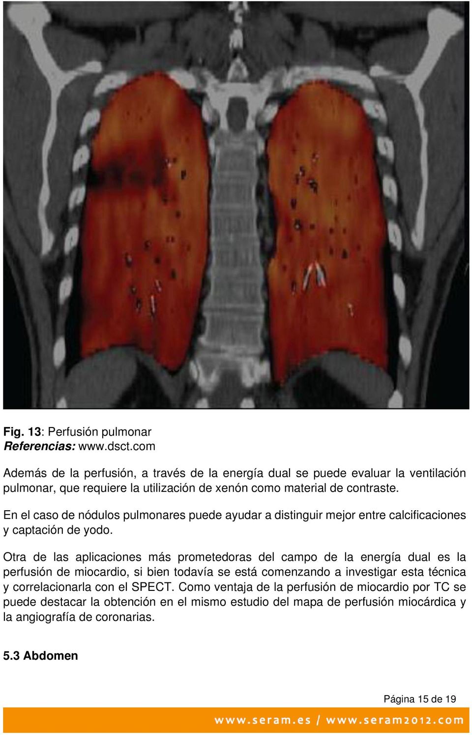 En el caso de nódulos pulmonares puede ayudar a distinguir mejor entre calcificaciones y captación de yodo.