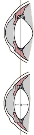 nervios ciliares cortos van al músculo tarsal superior (músculo liso) o, menos probable, al músculo elevador del párpado superior (músculo estriado), en vez de hacerlo al músculo dilatador de la