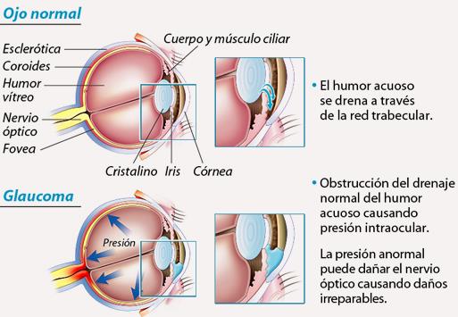 forma precoz. Glaucoma de ángulo cerrado El glaucoma de ángulo cerrado se instaura con mucha mayor rapidez y de hecho se conoce también como glaucoma agudo.