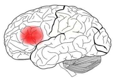 Dentro de las principales causas neurológicas capaces de producir alteraciones en el lenguaje encontramos: los accidentes cerebro-vasculares (ACV), los traumatismos cráneoencefálicos (TCE), los