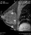 Recomendaciones de manejo de LI MRI- only Clínica Alemana 2008 Visible en Mx y/o US BI-RADS 3 Control con MX, US o RM 6 meses MRI-only Reevaluar clínica, Mx y US No visible en Mx y/o US BI-RADS 3