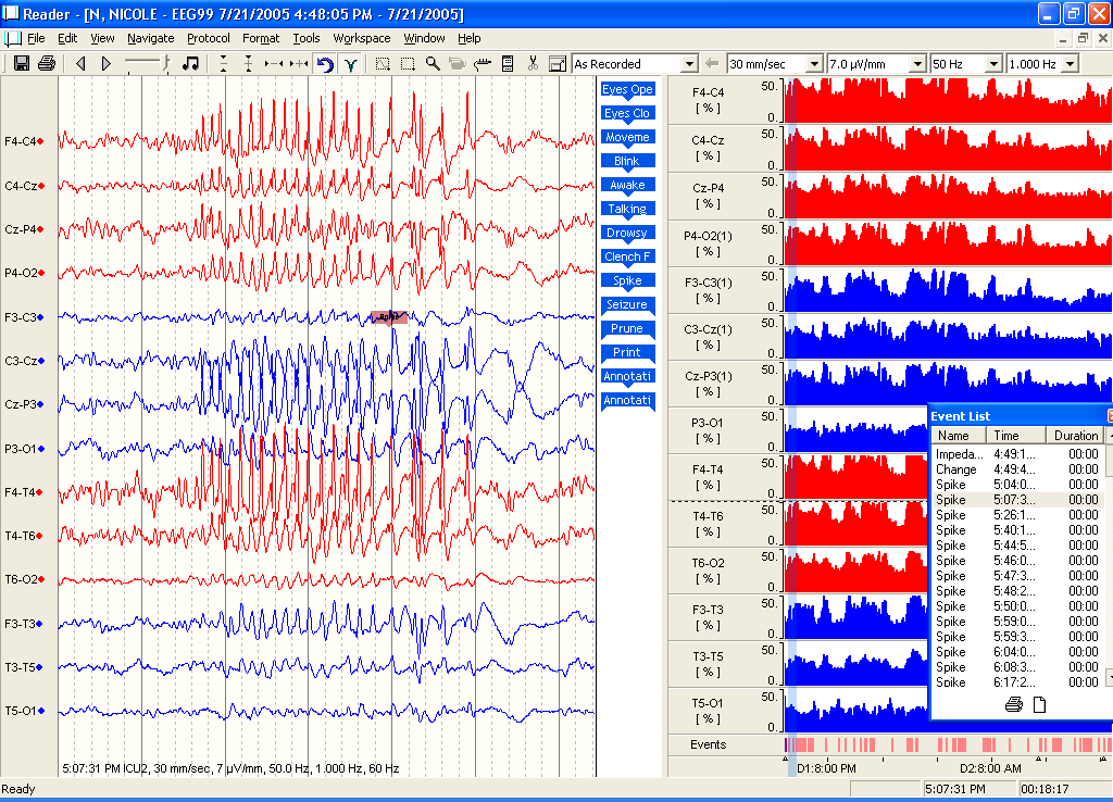 DIAGNOSTICO EEG Actividad epiléptica Descargas sincrónicas, paroxísticas, general.