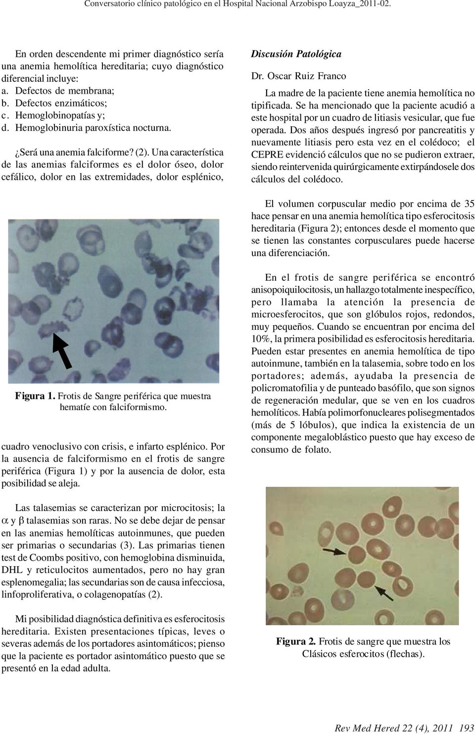 Hemoglobinuria paroxística nocturna. Será una anemia falciforme? (2).