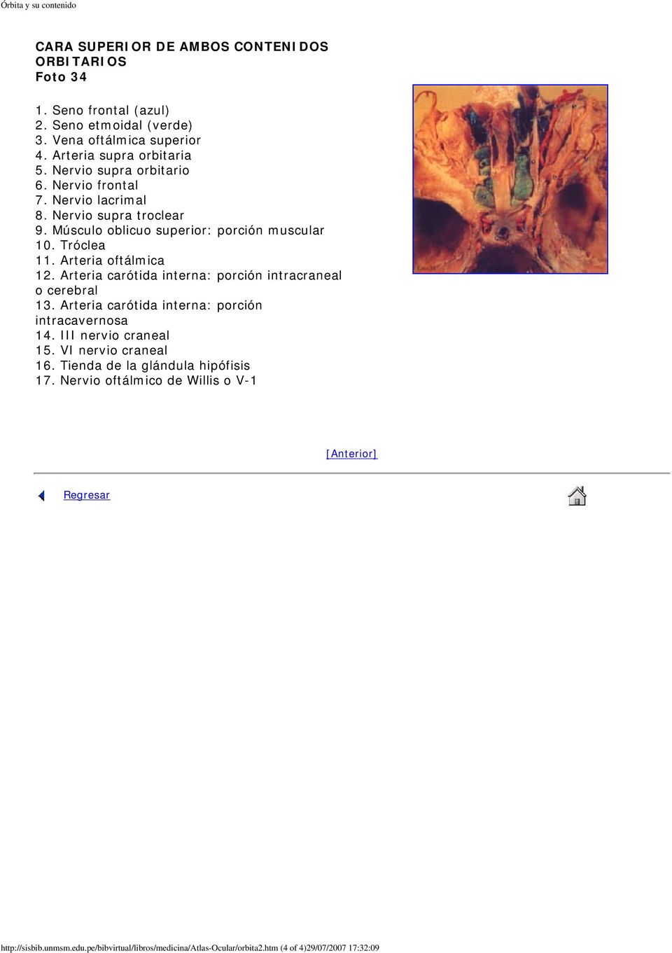 Arteria oftálmica 12. Arteria carótida interna: porción intracraneal o cerebral 13. Arteria carótida interna: porción intracavernosa 14. III nervio craneal 15.