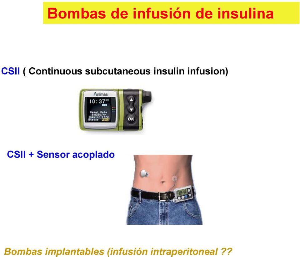 infusion) CSII + Sensor acoplado
