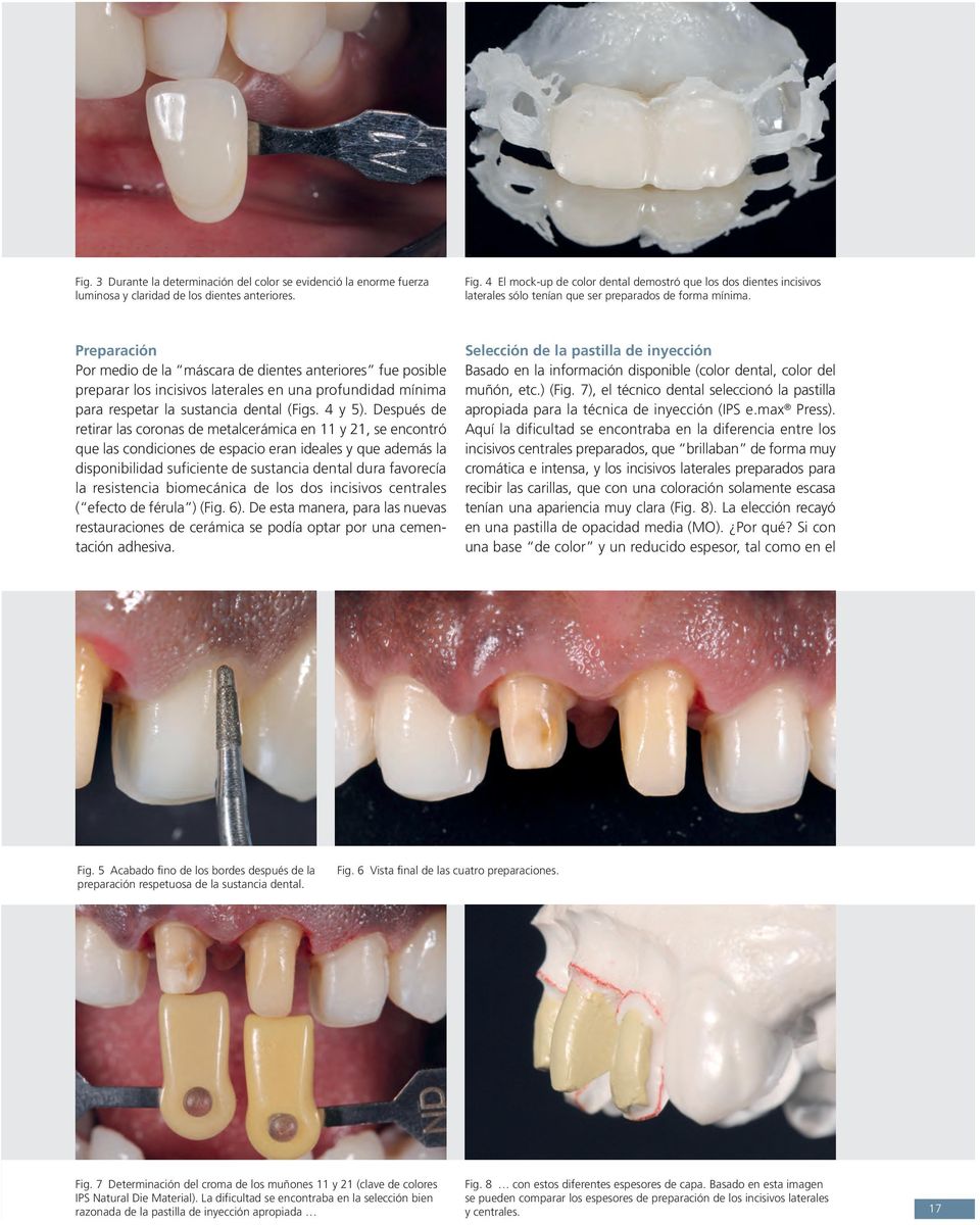 Preparación Por medio de la máscara de dientes anteriores fue posible preparar los incisivos laterales en una profundidad mínima para respetar la sustancia dental (Figs. 4 y 5).