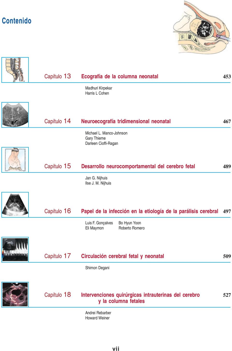 Nijhuis Capítulo 16 Papel de la infección en la etiología de la parálisis cerebral 497 Luis F.