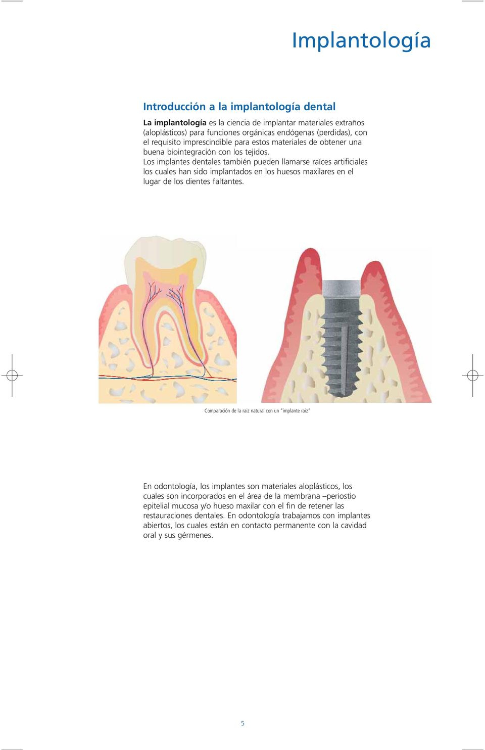 Los implantes dentales también pueden llamarse raíces artificiales los cuales han sido implantados en los huesos maxilares en el lugar de los dientes faltantes.
