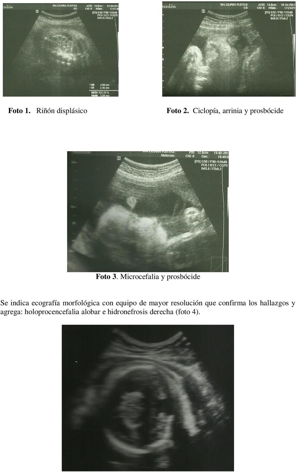 Microcefalia y prosbócide Se indica ecografía morfológica con