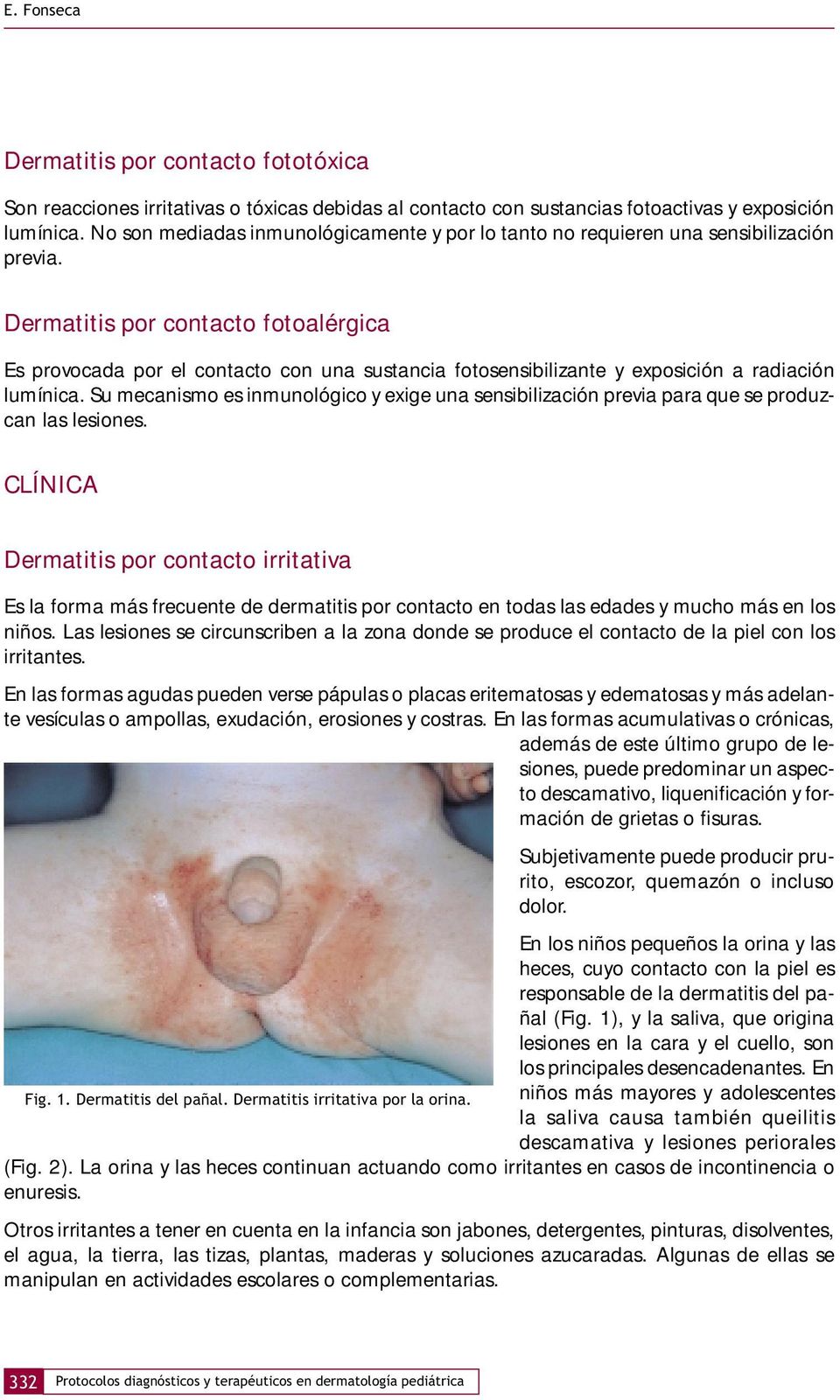 Dermatitis por contacto fotoalérgica Es provocada por el contacto con una sustancia fotosensibilizante y exposición a radiación lumínica.