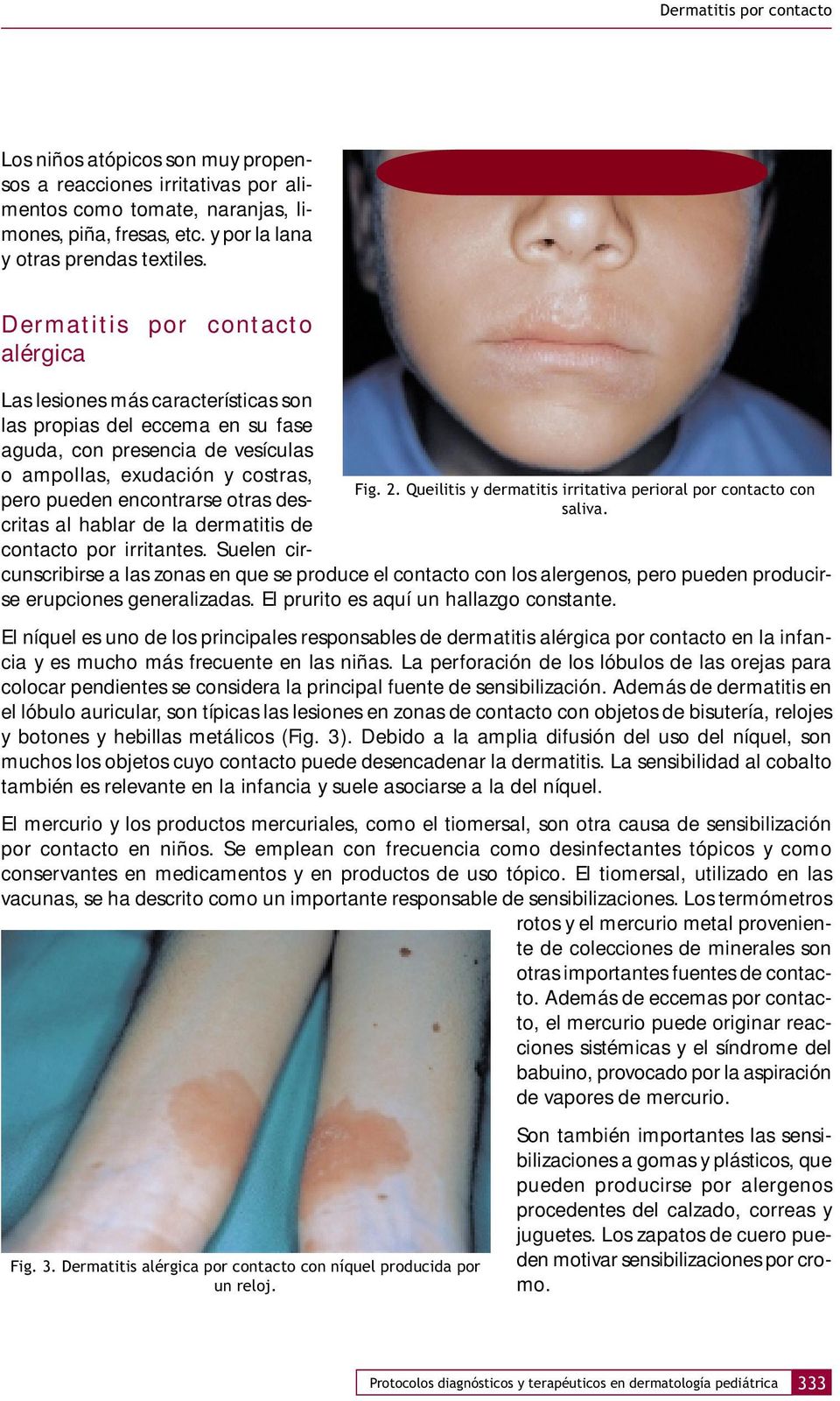 otras descritas al hablar de la dermatitis de contacto por irritantes.