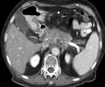 Carcinoma de páncreas Masa hipoecoica en ecografía e hipodensa en TC que realza mínimamente en comparación con parenquima normal.