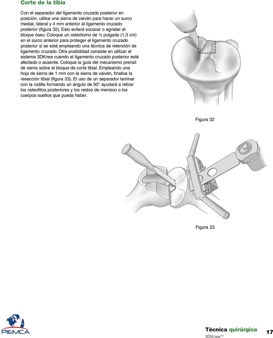 Coloque un osteótomo de ½ pulgada (1,3 cm) en el surco anterior para proteger el ligamento cruzado posterior si se está empleando una técnica de retención de ligamento cruzado.