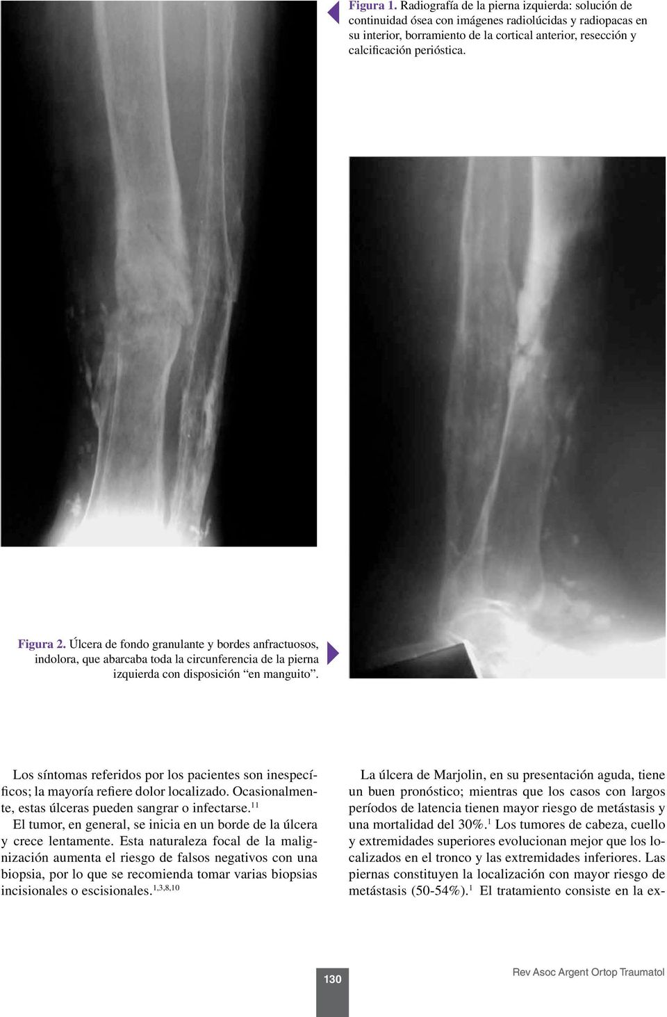 Figura 2. Úlcera de fondo granulante y bordes anfractuosos, indolora, que abarcaba toda la circunferencia de la pierna izquierda con disposición en manguito.