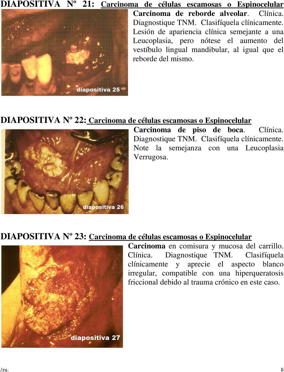 DIAPOSITIVA Nº 22: Carcinoma de células escamosas o Espinocelular Carcinoma de piso de boca. Clínica. Diagnostique TNM. Clasifíquela clínicamente. Note la semejanza con una Leucoplasia Verrugosa.