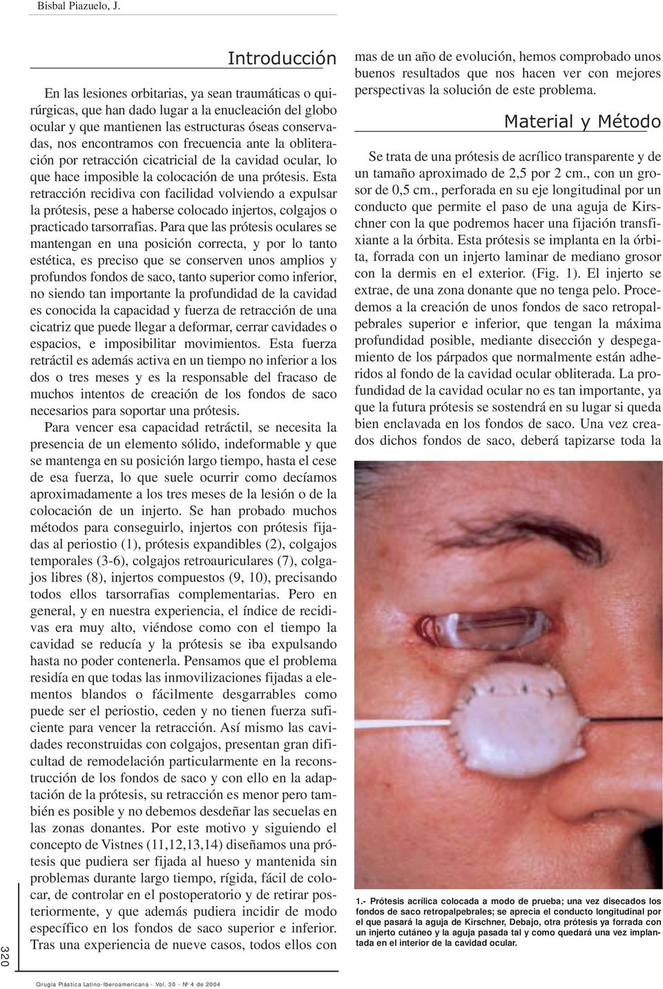 con frecuencia ante la obliteración por retracción cicatricial de la cavidad ocular, lo que hace imposible la colocación de una prótesis.