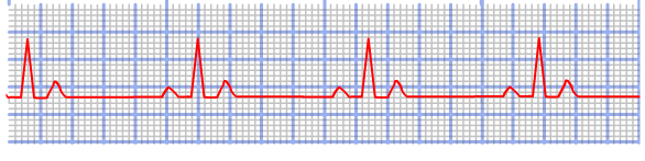 Capítulo 5 Material y Metodología FIGURA 5.19: ECG con ritmo sinusal normal 5.5.2. Bradicardia sinusal Este tipo de señal provoca una frecuencia cardiaca inferior a 6 latidos por minuto.