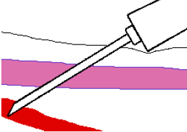 d) d) e) 7.- como prevenir Hematomas: Puncione solamente la pared superior de la vena. Remueva el torniquete antes de remover la aguja. Escoja las venas superficiales mayores.