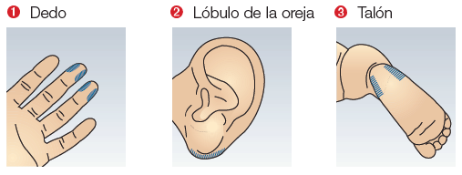 baja del lóbulo de la oreja y en niños, las áreas laterales del talón.