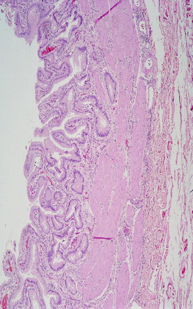 Vesícula biliar La vesícula biliar se conecta con el hígado a través del conducto del cístico que se une con el conducto biliar común Epitelio