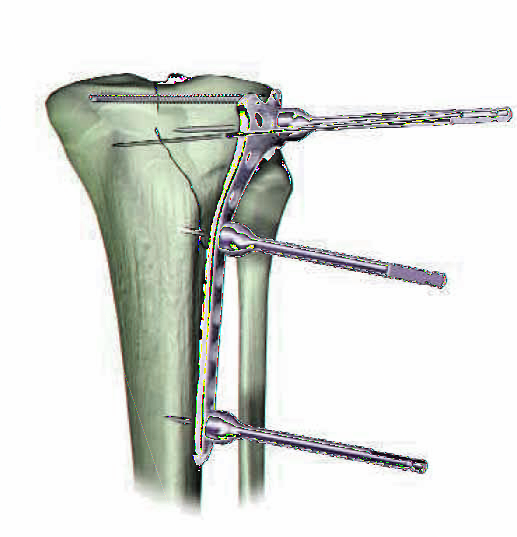 Placa Tibial Proximal Lateral, de 4,5 mm Reducción Articular y Fijación Provisional Es importante lograr la reducción de la fractura articular antes de colocar los tornillos de bloqueo.