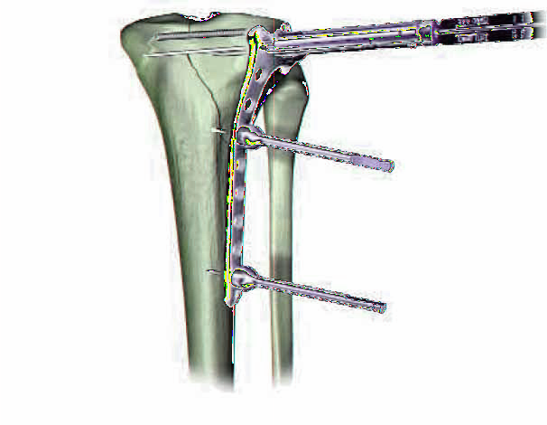 Placa Tibial Proximal Lateral, de 4,5 mm Inserción de los Tornillos Se puede lograr una reducción con clamp o con tornillos de compresión, fuera de la placa, o a través de ella.