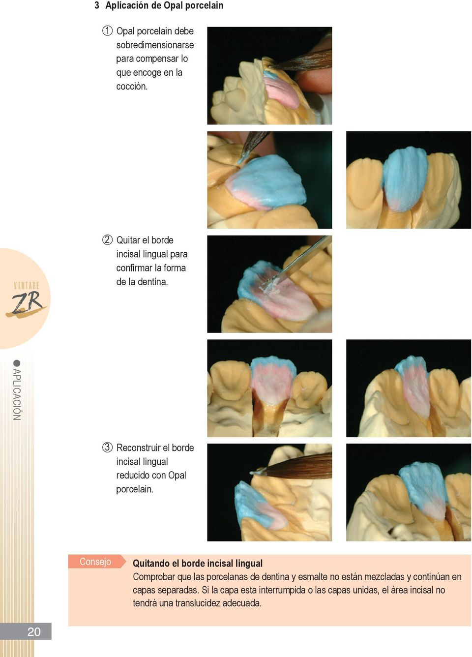 APLICACIóN 3 Reconstruir el borde incisal lingual reducido con opal porcelain.