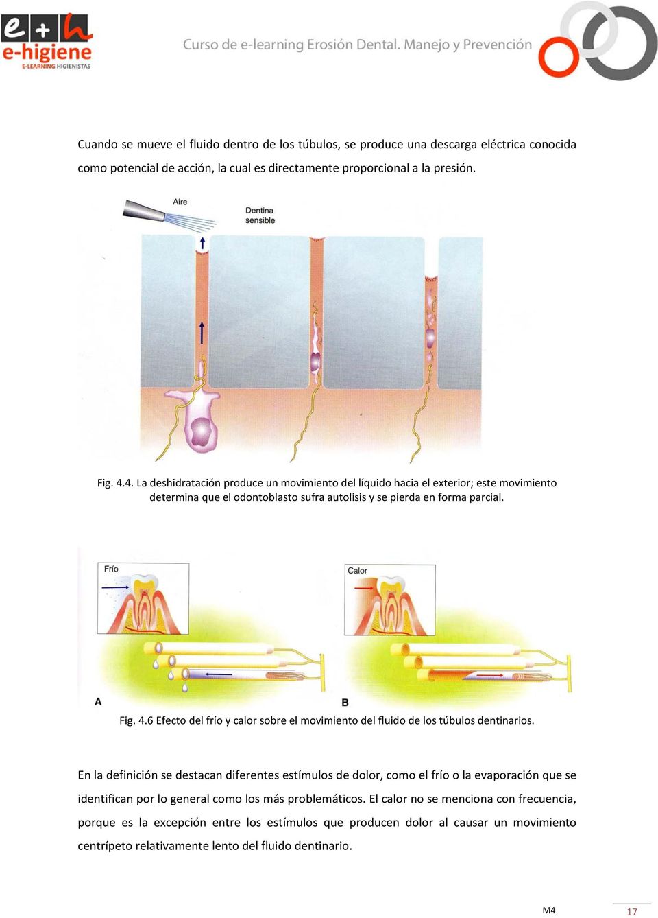 6 Efecto del frío y calor sobre el movimiento del fluido de los túbulos dentinarios.