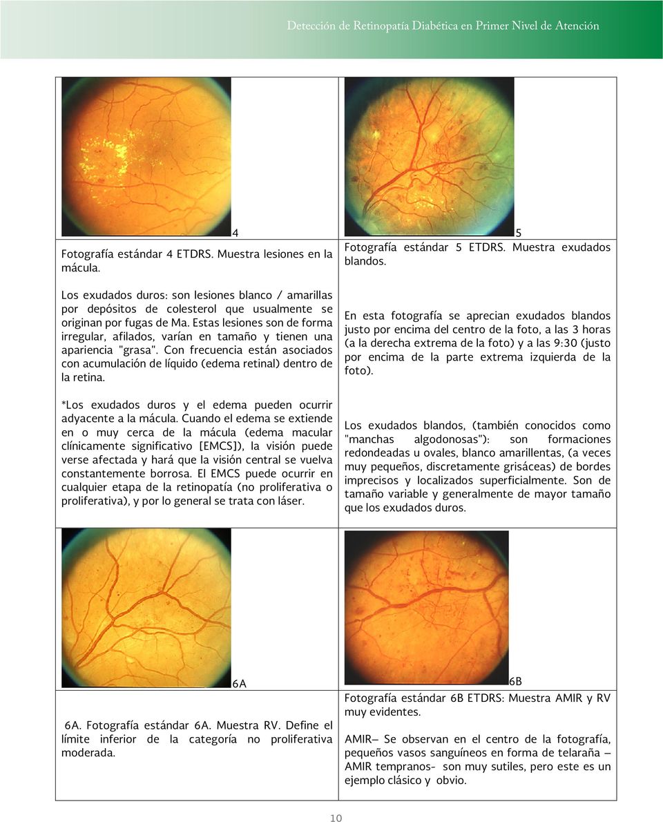 Estas lesiones son de forma irregular, afilados, varían en tamaño y tienen una apariencia "grasa". Con frecuencia están asociados con acumulación de líquido (edema retinal) dentro de la retina.