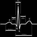 La onda P corresponde a la activación auricular, el complejo QRS a la activación (despolarización) ventricular y la onda T a la repolarización ventricular.