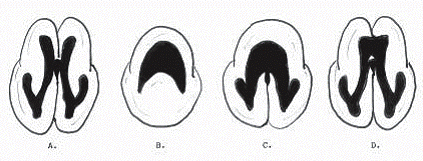 ausencia de Septum Pellucidum e hipoplasia de astas frontales y cisura