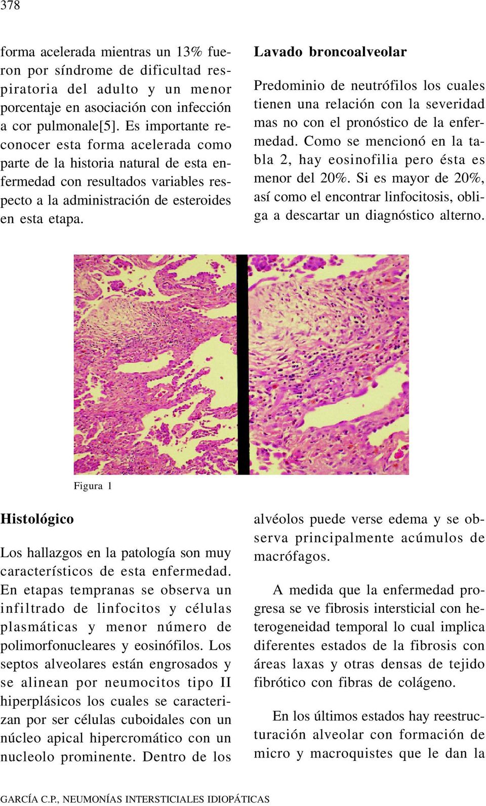 Lavado broncoalveolar Predominio de neutrófilos los cuales tienen una relación con la severidad mas no con el pronóstico de la enfermedad.