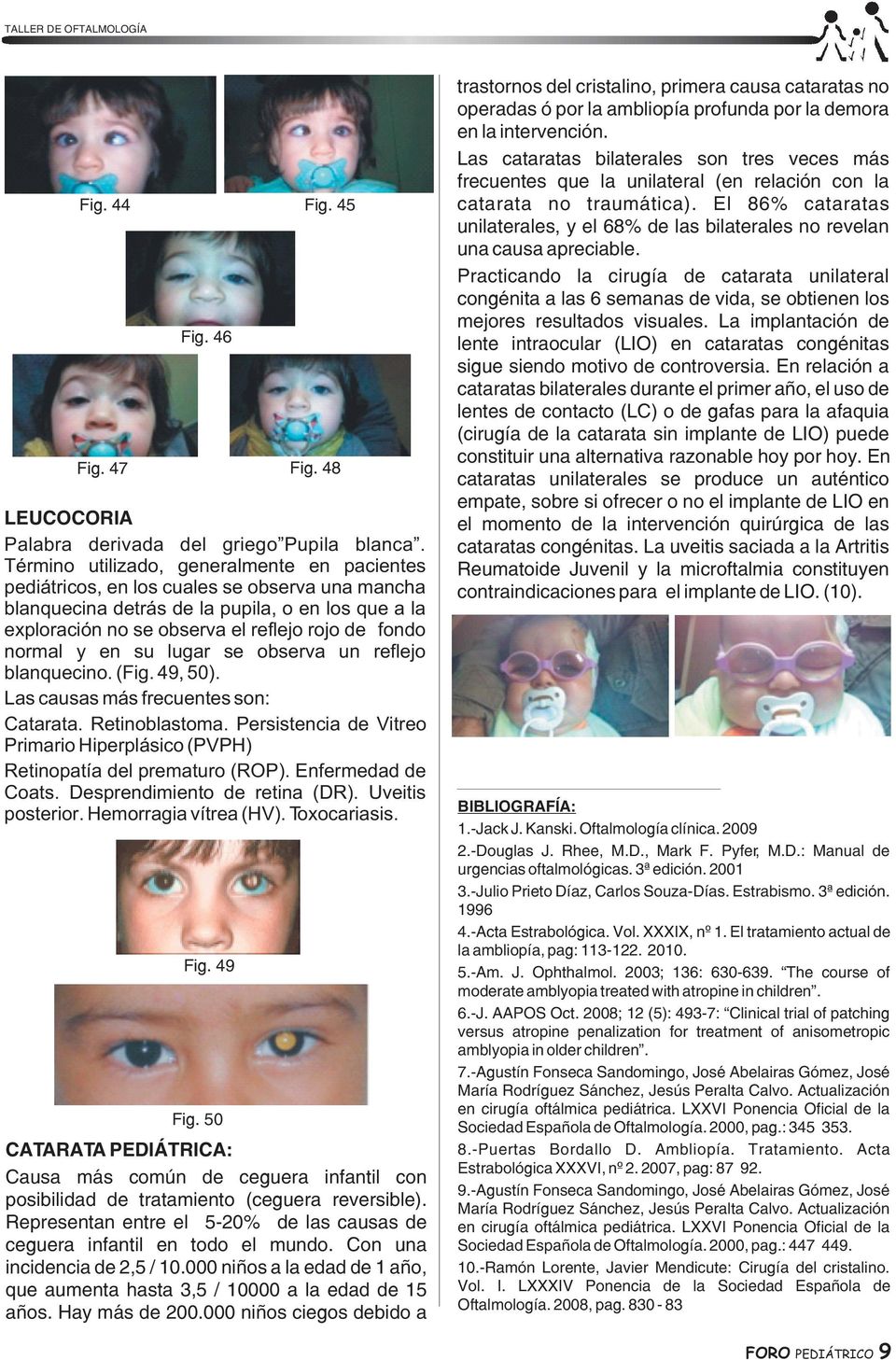 normal y en su lugar se observa un reflejo blanquecino. (Fig. 49, 50). Las causas más frecuentes son: Catarata. Retinoblastoma.