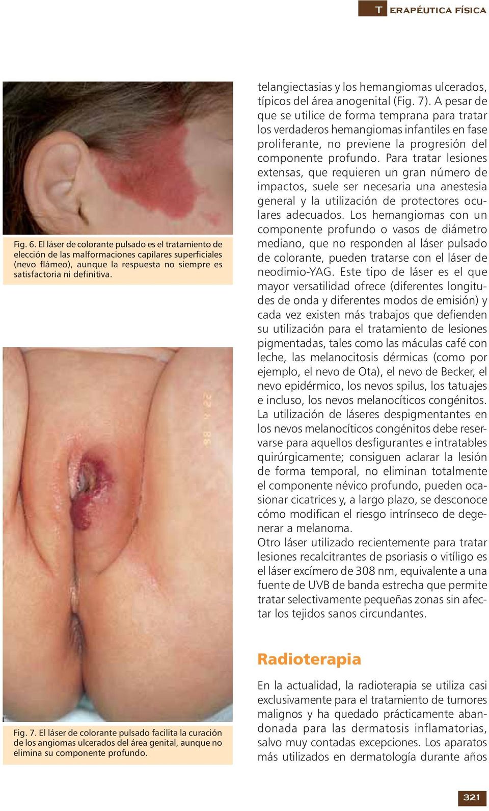 telangiectasias y los hemangiomas ulcerados, típicos del área anogenital (Fig. 7).