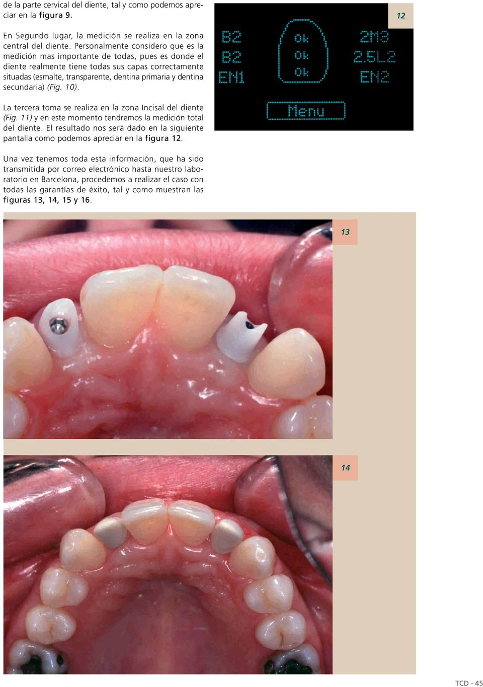 secundaria) (Fig. 10). La tercera toma se realiza en la zona Incisal del diente (Fig. 11) y en este momento tendremos la medición total del diente.