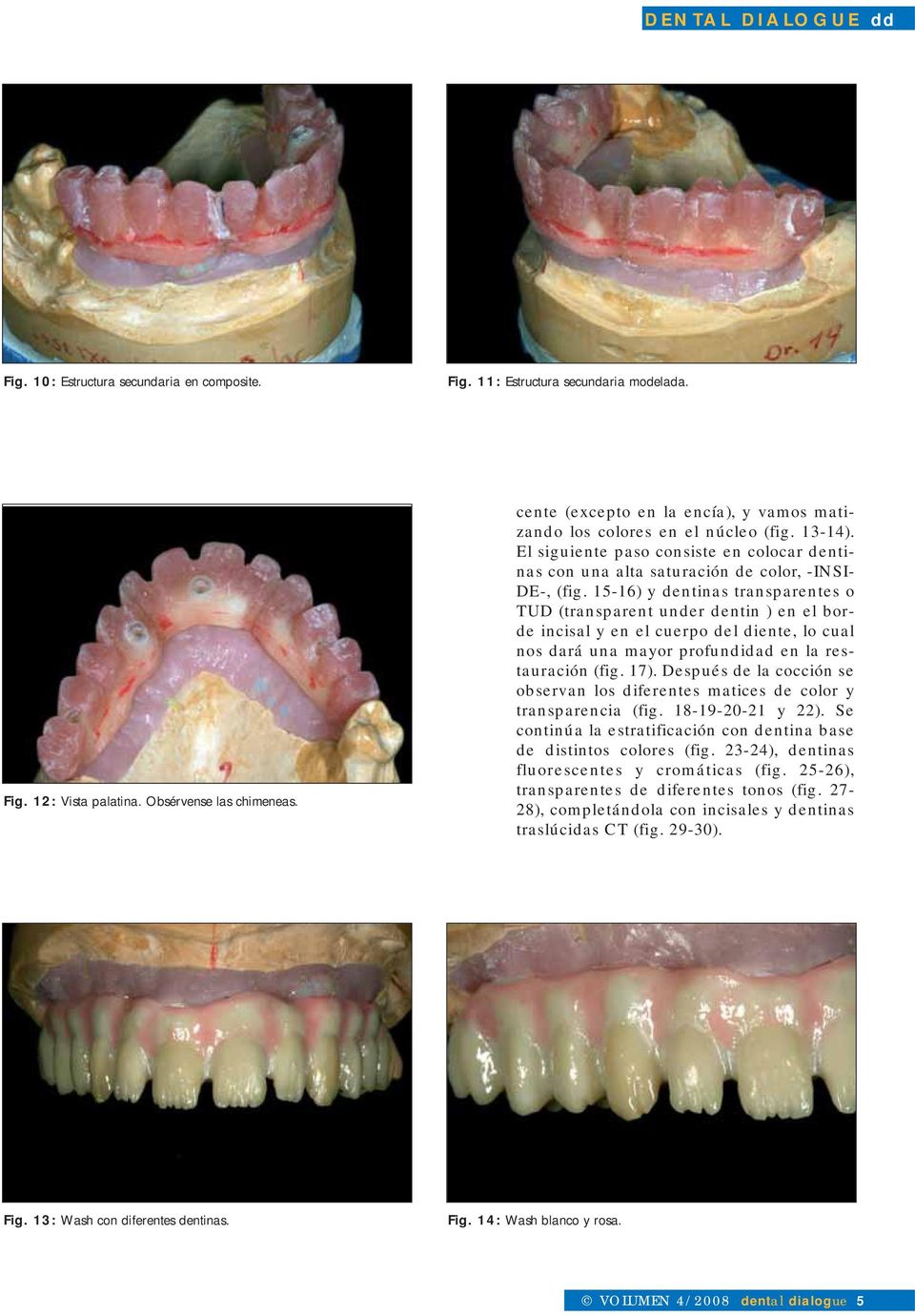 15-16) y dentinas transparentes o TUD (transparent under dentin ) en el borde incisal y en el cuerpo del diente, lo cual nos dará una mayor profundidad en la restauración (fig. 17).