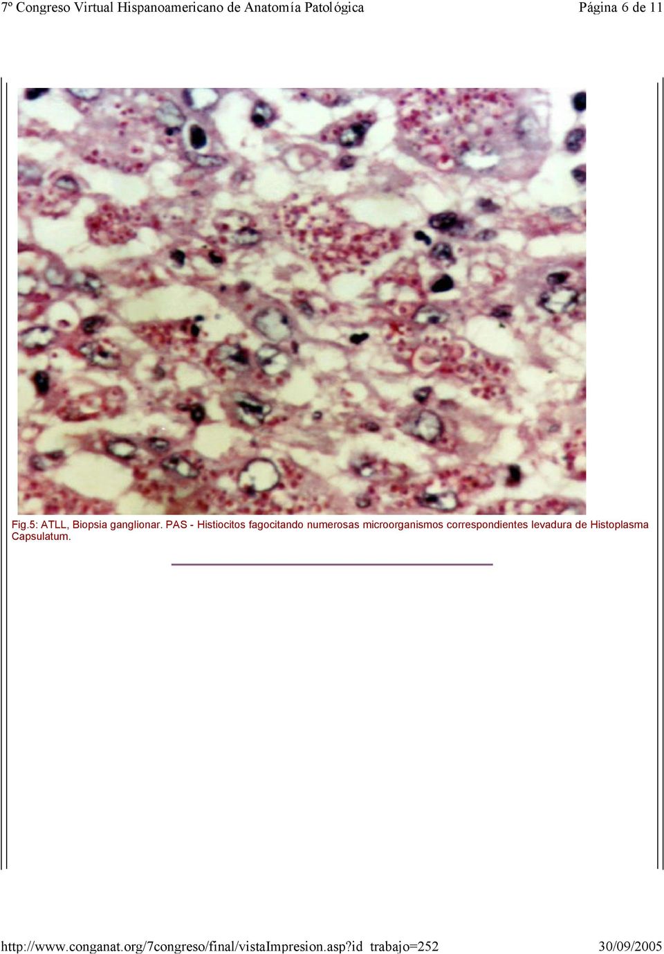 PAS - Histiocitos fagocitando