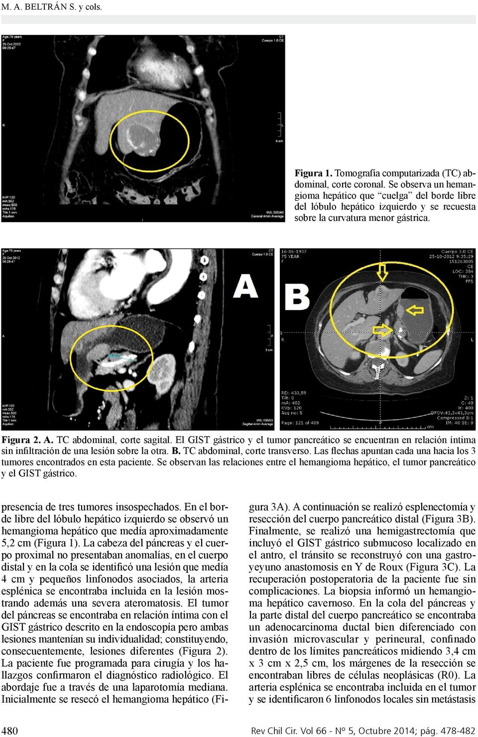 El GIST gástrico y el tumor pancreático se encuentran en relación íntima sin infiltración de una lesión sobre la otra. B. TC abdominal, corte transverso.