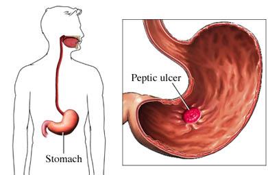 Las úlceras son llagas en el tejido de revestimiento del tubo digestivo.