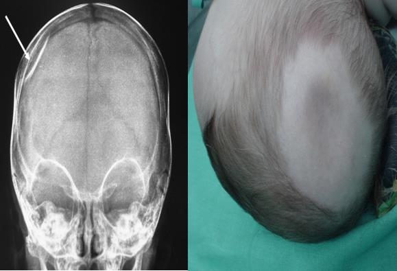 FRACTURAS DEPRIMIDAS Cuando una porción ósea del cráneo ha sido desplazada por debajo de la tabla interna del hueso circundante Niños bola de