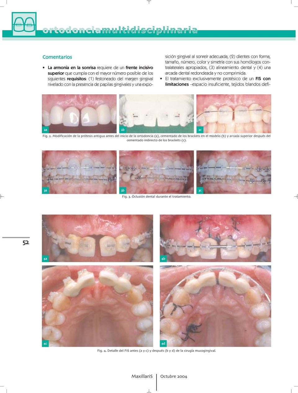 dental y (4) una arcada dental redondeada y no comprimida. El tratamiento exclusivamente protésico de un FIS con limitaciones espacio insuficiente, tejidos blandos defi- c Fig.