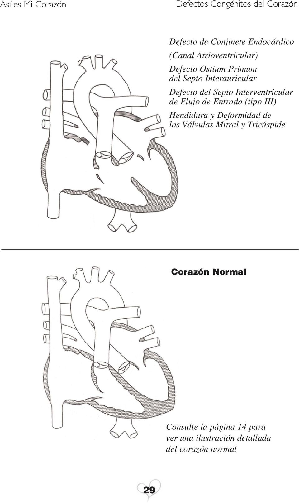 (tipo III) Hendidura y Deformidad de las Válvulas Mitral y Tricúspide Corazón