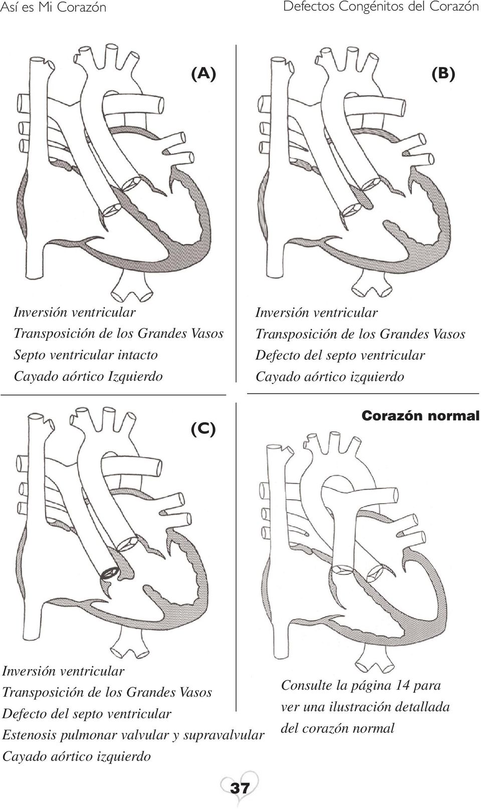 Corazón normal Inversión ventricular Transposición de los Grandes Vasos Defecto del septo ventricular Estenosis pulmonar