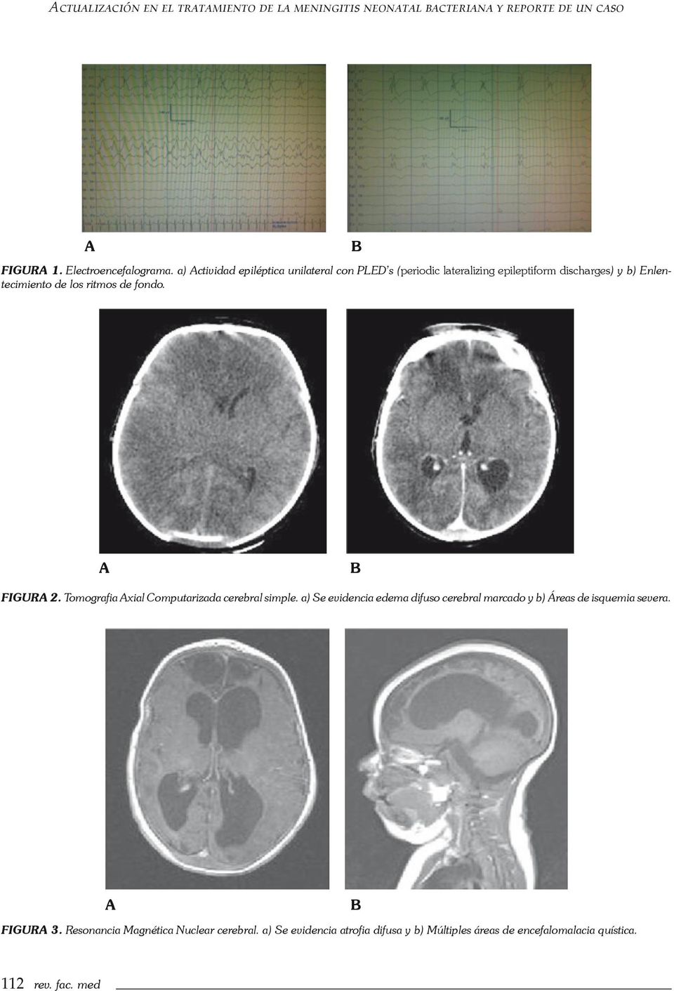 B A B Figura 2. Tomografia Axial Computarizada cerebral simple.