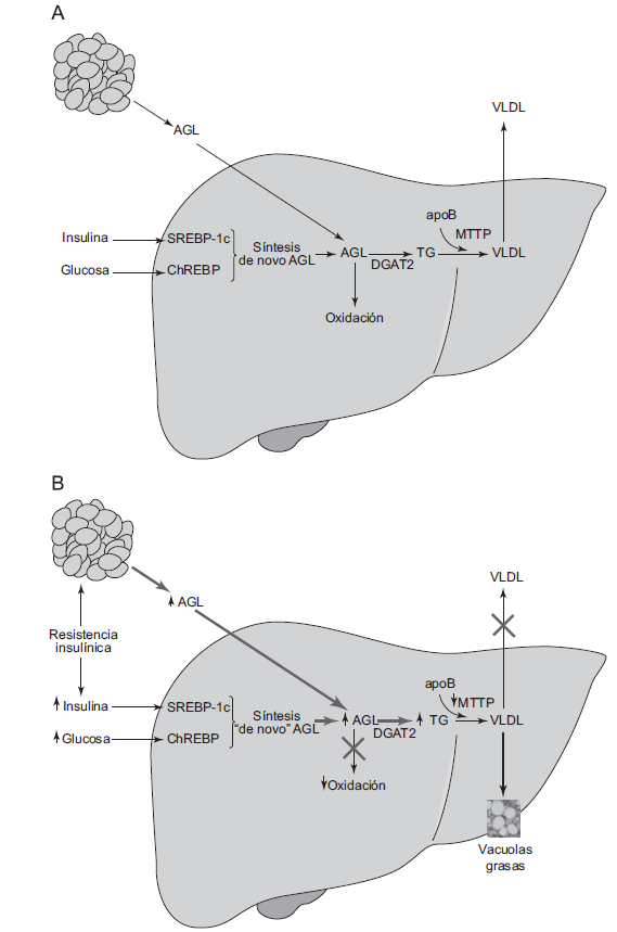 Introducción Figura 8. A: Síntesis hepática normal de triglicéridos y VLDL. B: Fisiopatología de la EHGNA.
