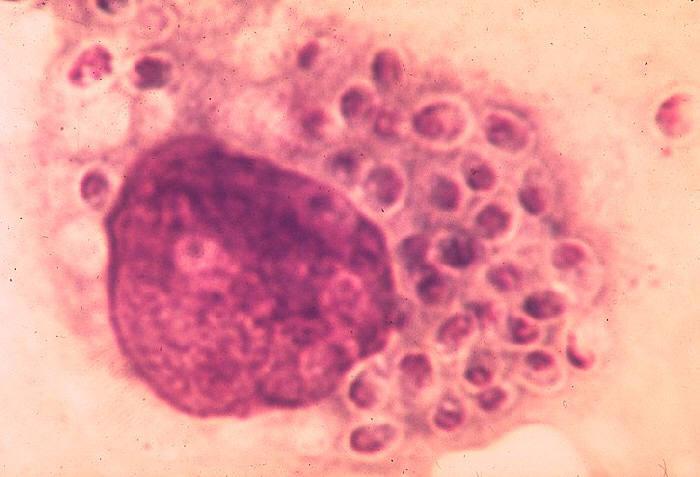 Histoplasmosis Fase Parasitaria o Levaduriforme: Levadura ovoide con tinción en casquete o en medialuna por la cromatina polarizada (Giemsa) con halo claro alrededor por la