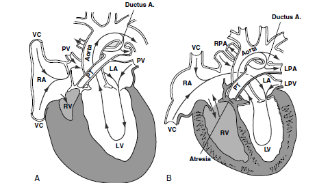 Radiografía de tórax: Se observa un corazón en forma de bota debido a la elevación de la punta del corazón a causa de hipertrofia del VD y la concavidad en la arteria pulmonar principal 49,50.