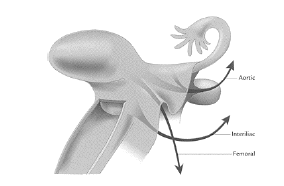 La inyección en la subserosa uterina, según la técnica de Burke y cols, mediante tres puntos en la línea media del fundus y uno anterior y otro posterior a 2 cms del primero, ha
