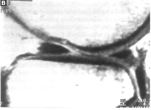 Figura 3. Paciente con lesión OC contigua al hueso subcondral, con depresión cortical (grado III). Cortes sagitales de RM. A) La RM muestra en el preoperatorio el edema en forma de medialuna.
